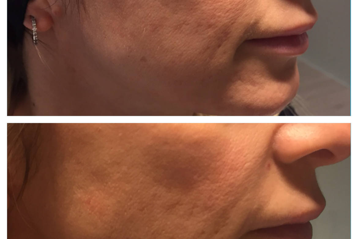 Trattamenti estetici cicatrici acne